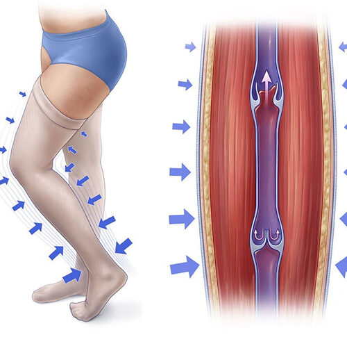 La terapia compressiva medica